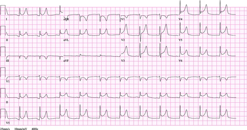 ECG of Acute Percarditis