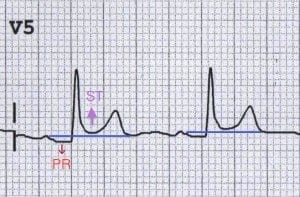 pericarditis ecg